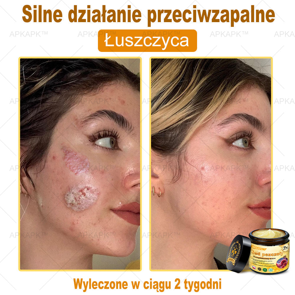 ΑPΚΑPK™ Jad Pszczoły Kompleksowy Krem🥇🥇pomaga w leczeniu problemów skórnych, takich jak: zmarszczki, blizny, plamy pigmentacyjne, rozstępy, trądzik, łuszczyca, egzema, zmiany skórne, podrażnienia, stany zapalne i inne problemy skórne🔥