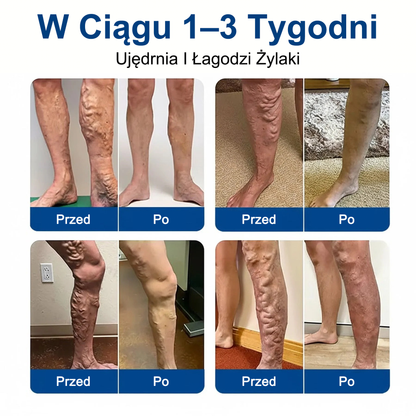 👨‍⚕️🔥Płatki pielęgnacyjne z mikronakłuwaniem GFOUK® VeinEase⚡Natychmiastowa ulga, długotrwałe rezultaty